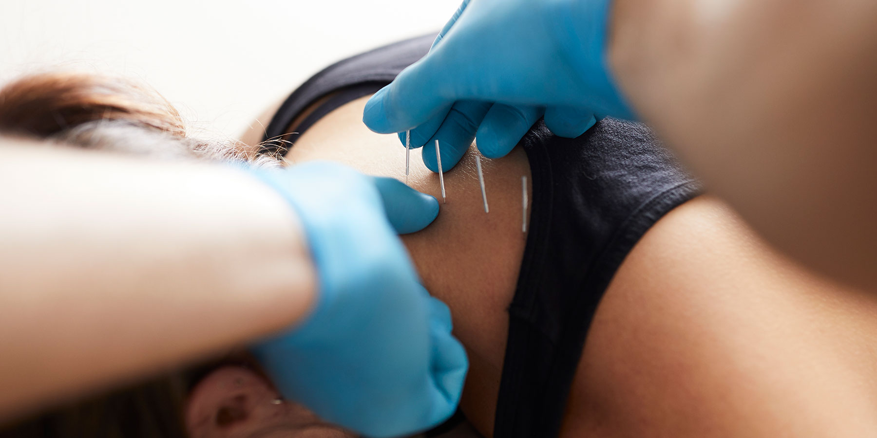 Acupuncturist putting needles in the back and neck area of a patient.