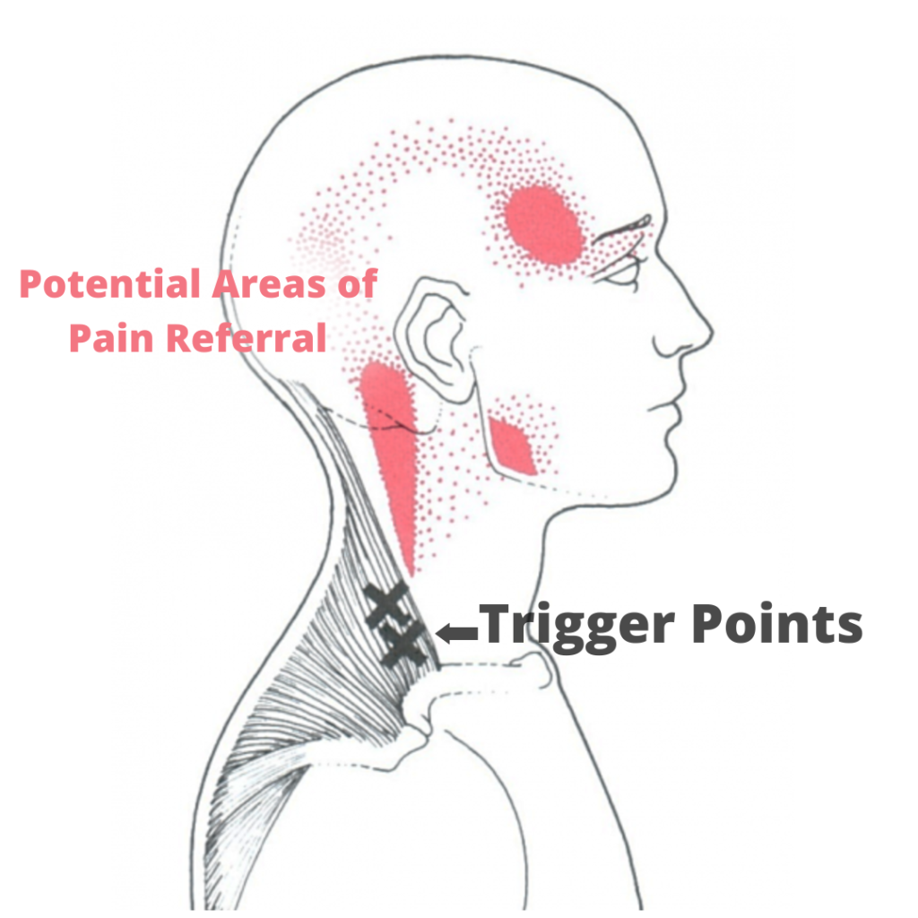 Dry Needling for Neck Pain TruMotion Therapy Chiropractor