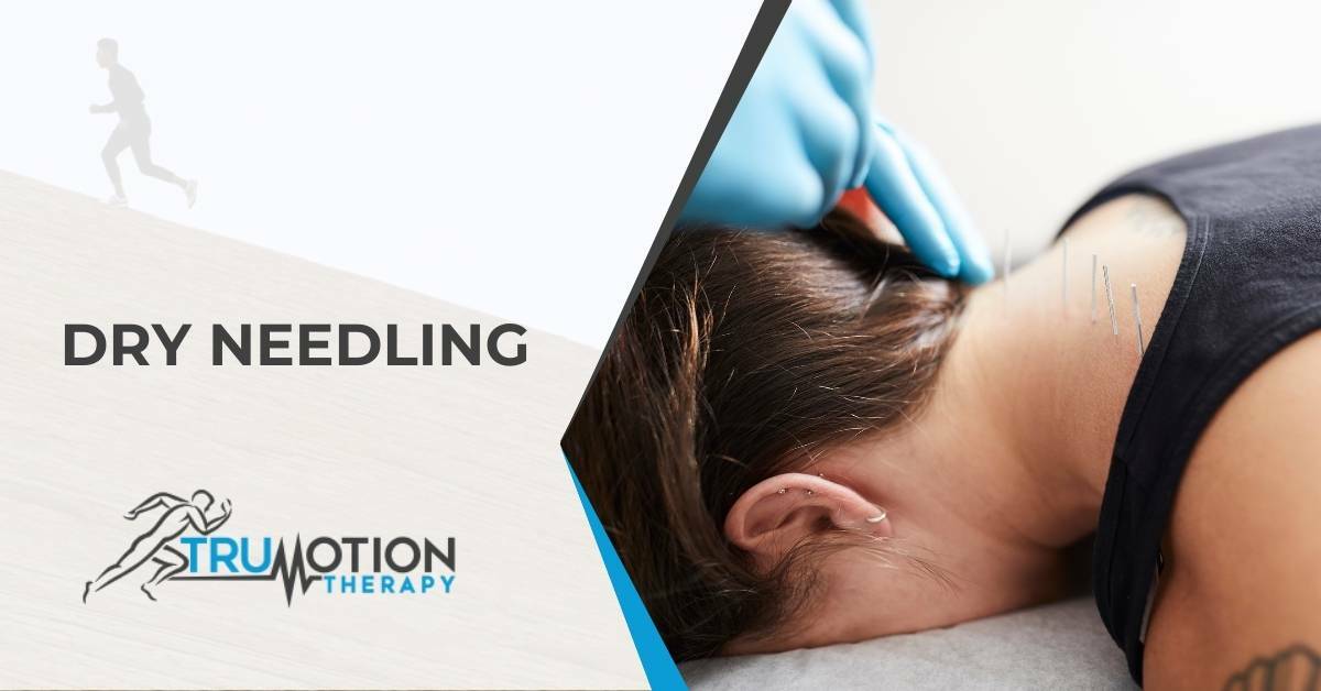 Dry Needles in the Back of the Neck of a Patient | Dry Needling in Charlotte, NC | TruMotion Therapy